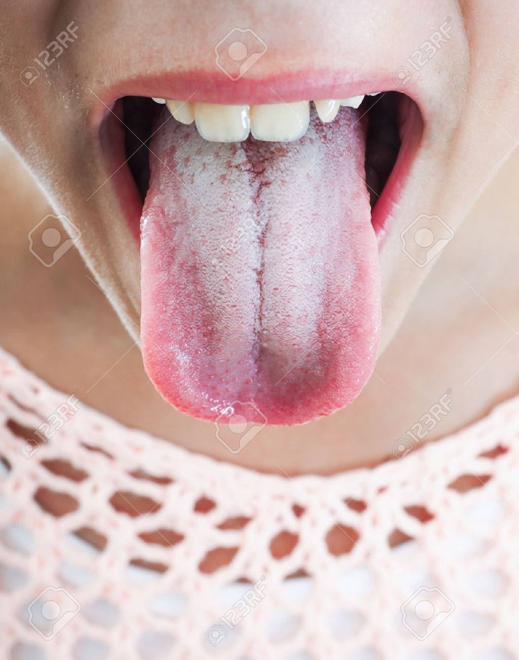Язык белый вяжет во рту что это Язык белый вяжет во рту что это