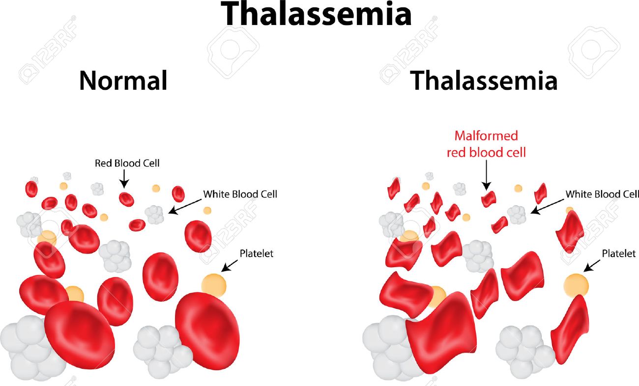 Alpha thalassemia in adults