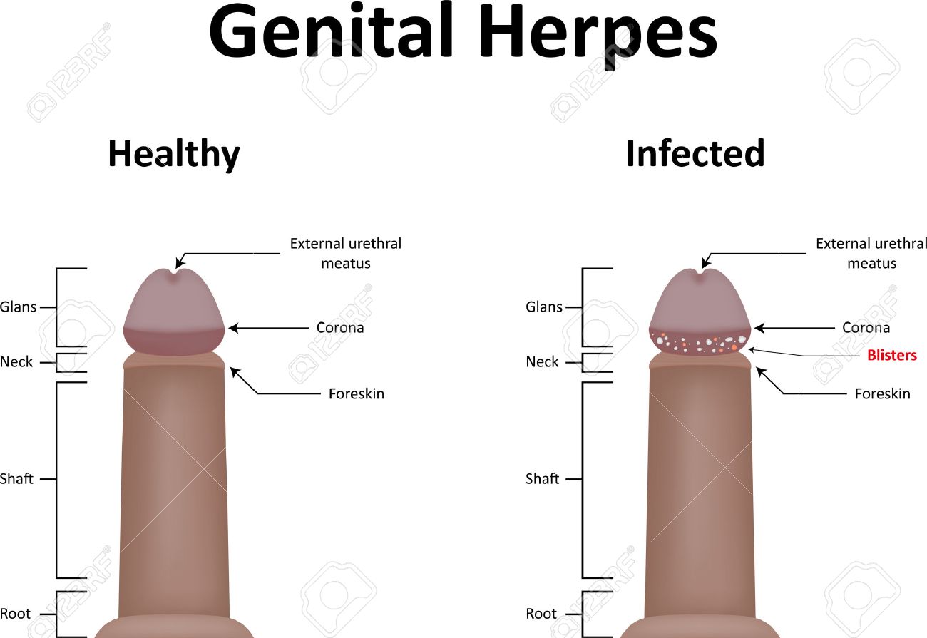 Anal psoriasis pain