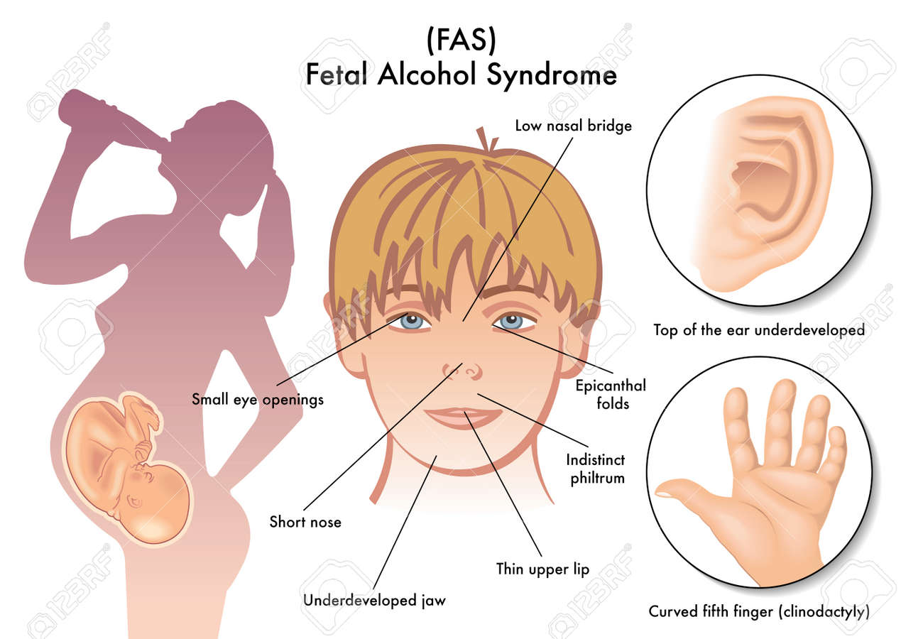 The Effects Of Maternal Alcohol Or Drug Abuse On The Developing Fetus The Effects Of Maternal Alcohol Or Drug Abuse On The Developing Fetus