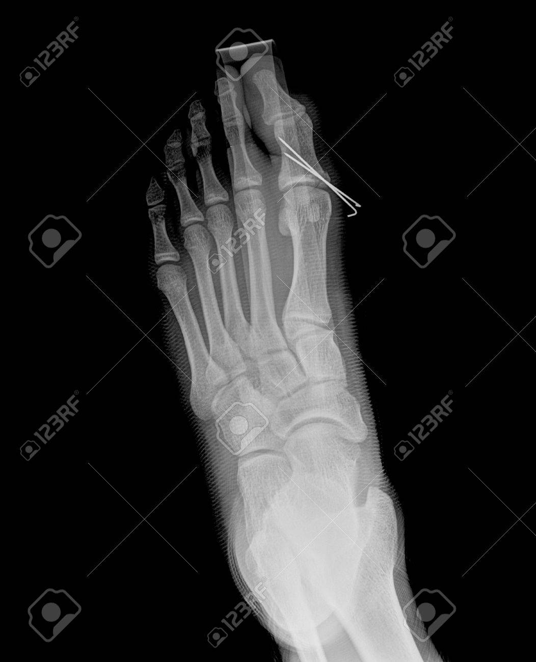homeopathic medicine reduce uric acid gout causes swelling penyakit gout artritis merupakan gangguan persendian yang di sebabkan oleh