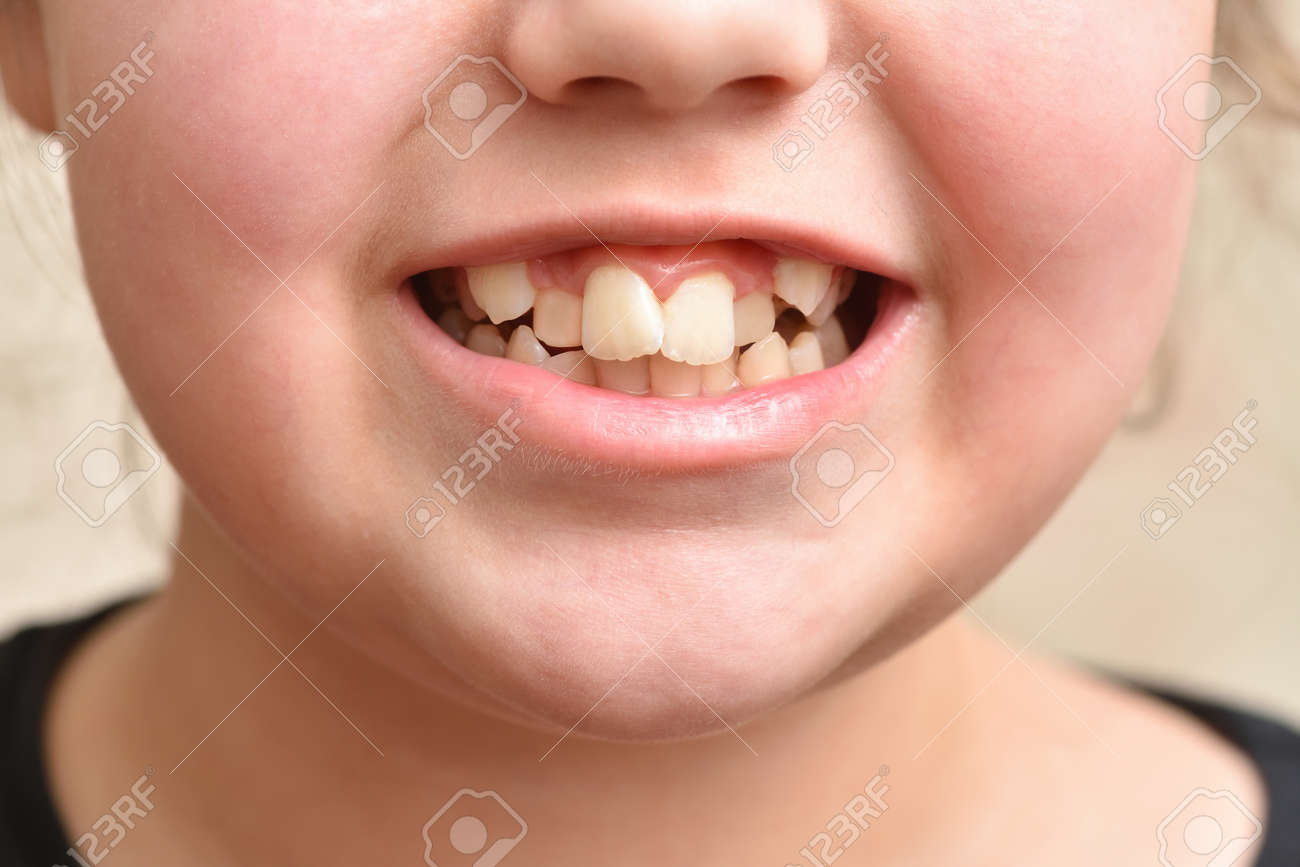 Crooked teeth in a child girl, close up - 169692418 Crooked teeth in a child girl, close up - 169692418