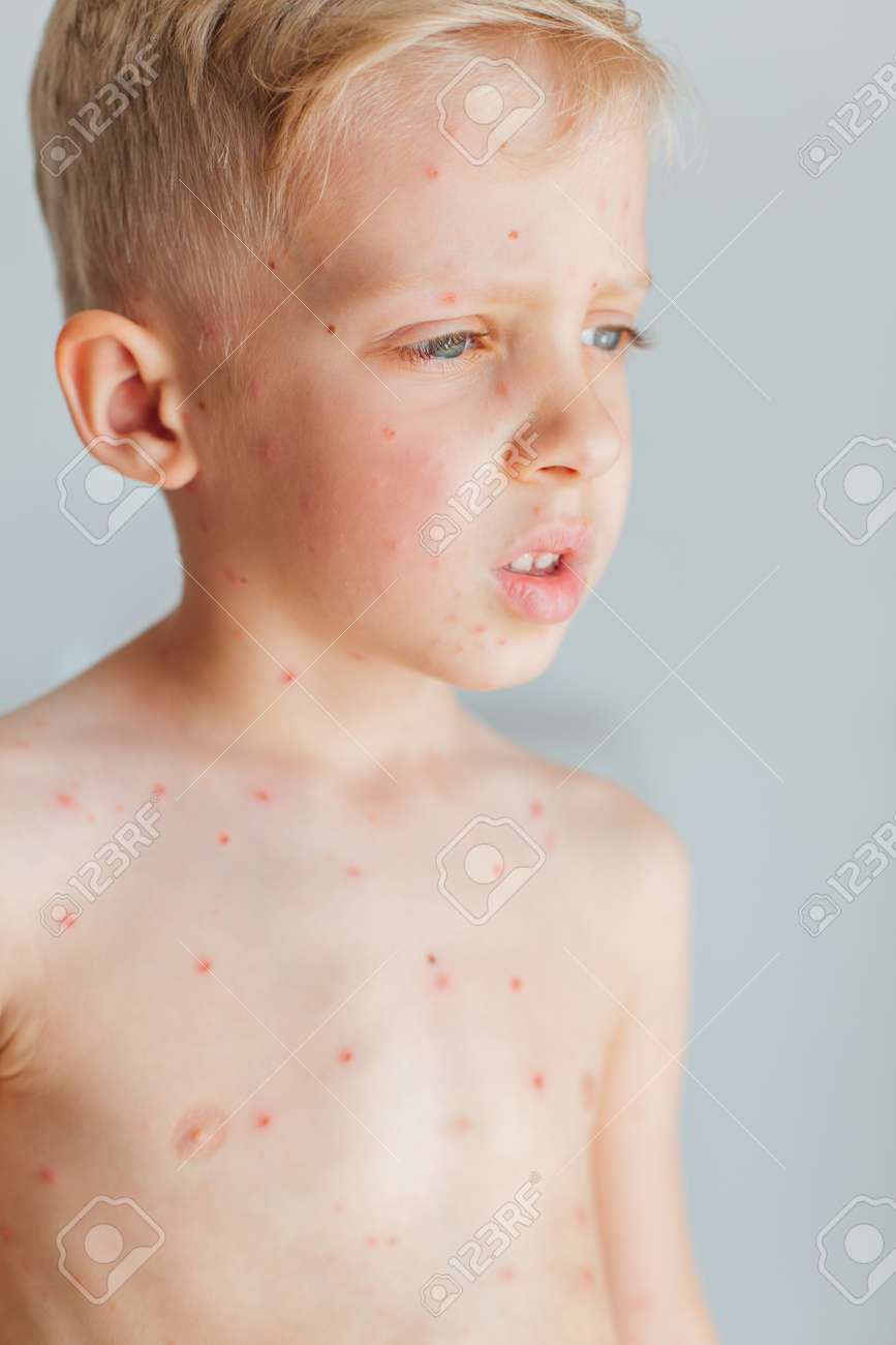 Sick Little Boy Varicella Virus Or Chickenpox Bubble Rash On