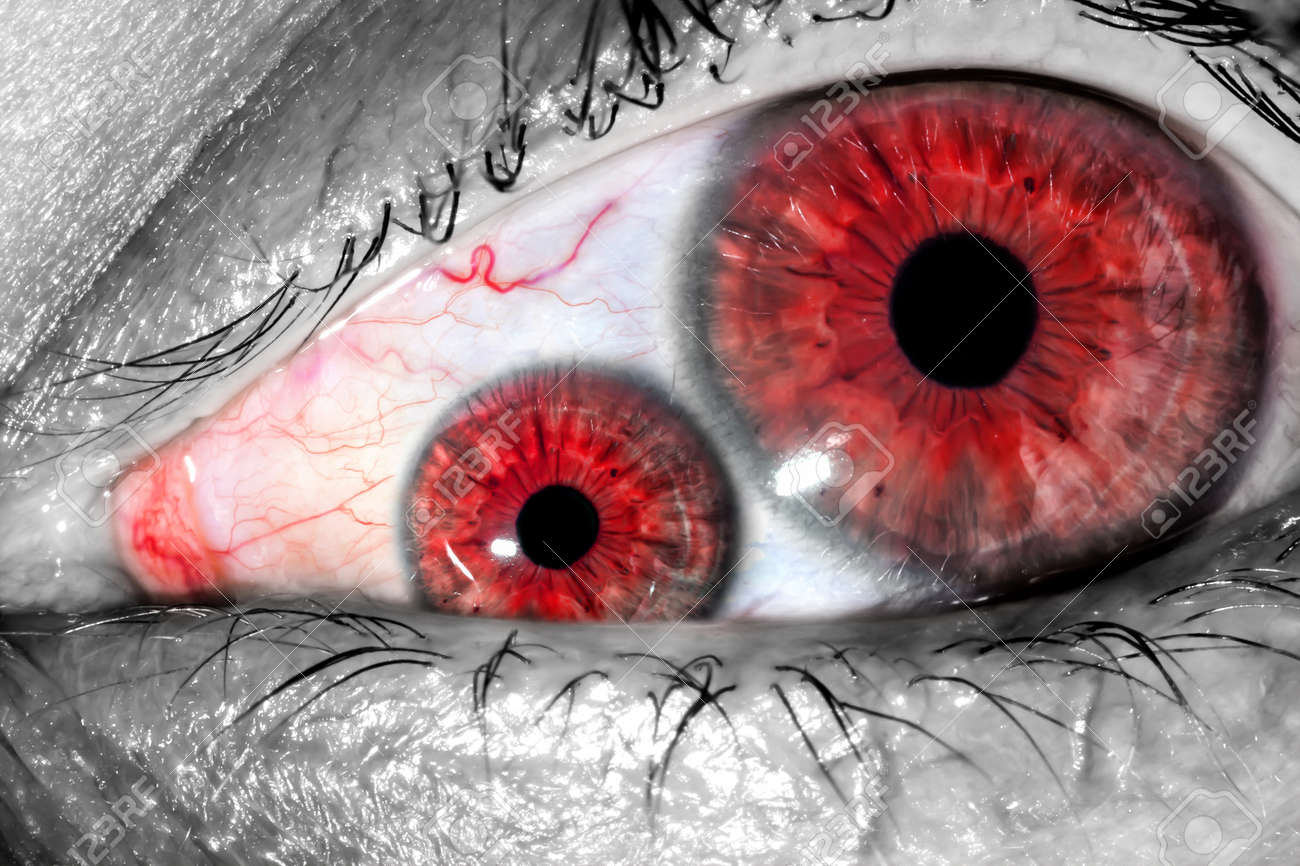 Human Eye With Two Pupils And Red Tight Veins On Protein Macro
