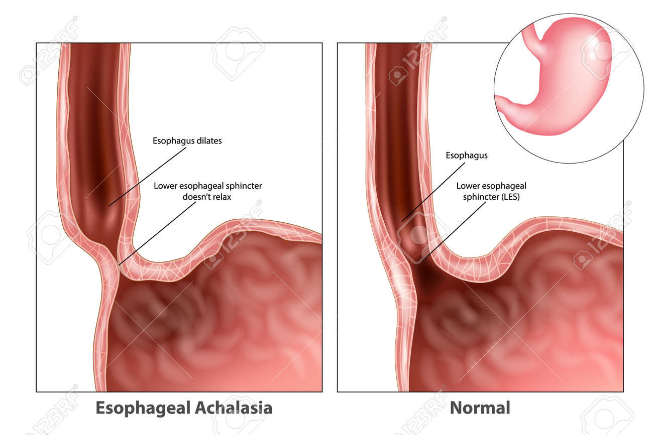 diagram of the lower esophageal sphincter wiring diagrams Diagram Of The Lower Esophageal Sphincter esophagus longitudinal muscle les