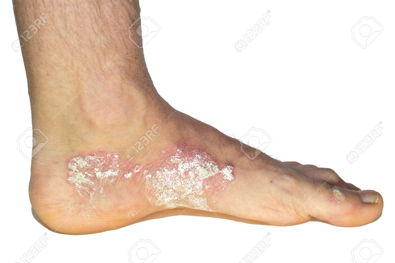psoriasis pied photo