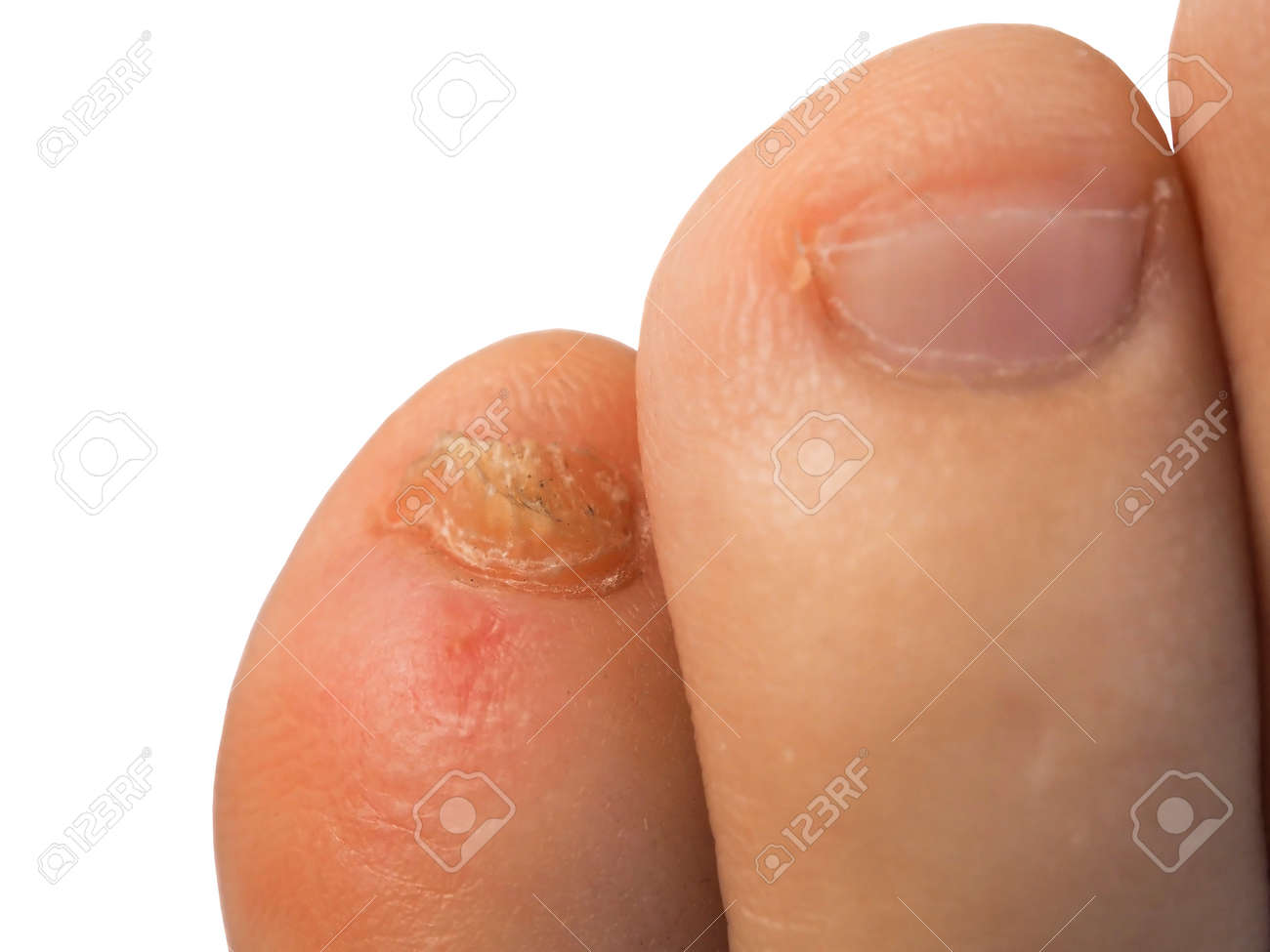 問題小指爪の白い背景の上のフィート の写真素材 画像素材 Image