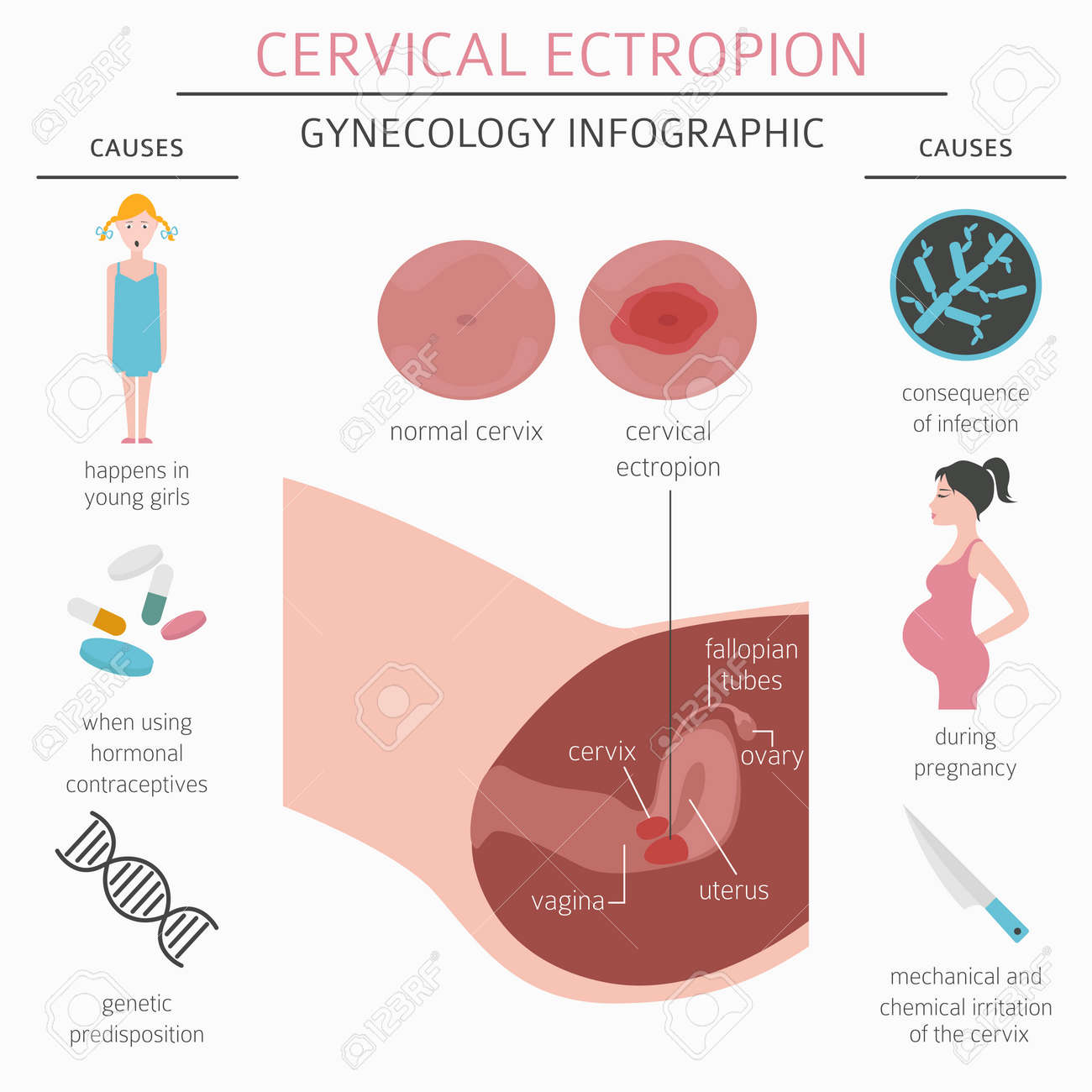 Cervical Ectropion Ginecological Medical Desease Infographic Vector Illustration Royalty Free Cliparts Vectors And Stock Illustration Image 103438117