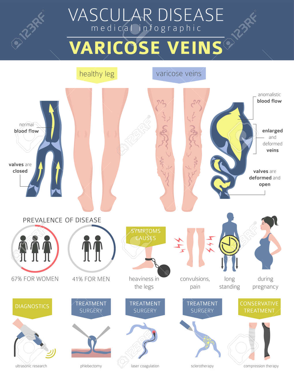 compression therapy for varicose veins