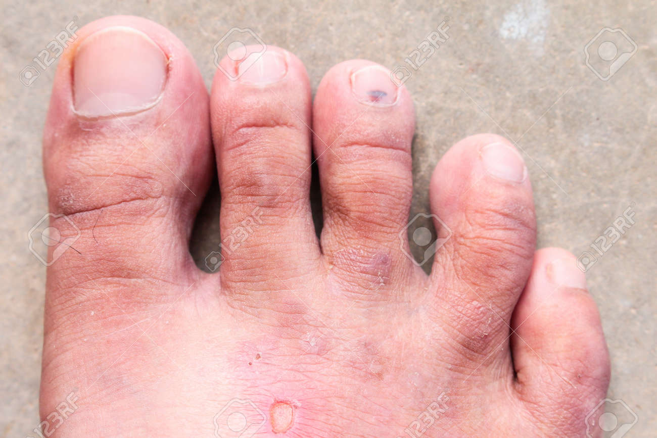 クローズ アップ肌水虫乾癬菌 香港足足病気 の写真素材 画像素材 Image 3395