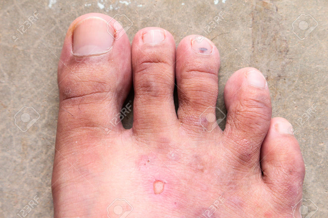クローズ アップ皮膚水虫乾癬菌 香港足 足の病気 の写真素材 画像素材 Image