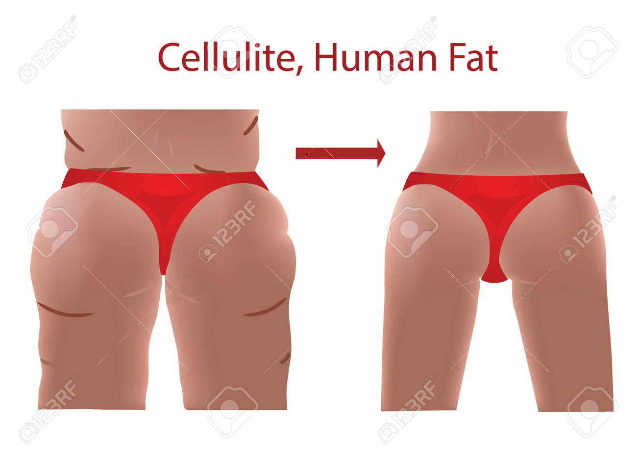 Fat Cellulite Butts Fat Cellulite Butts