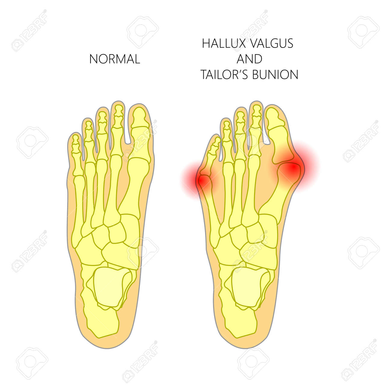 вальгусное отклонение 1 пальца стопы