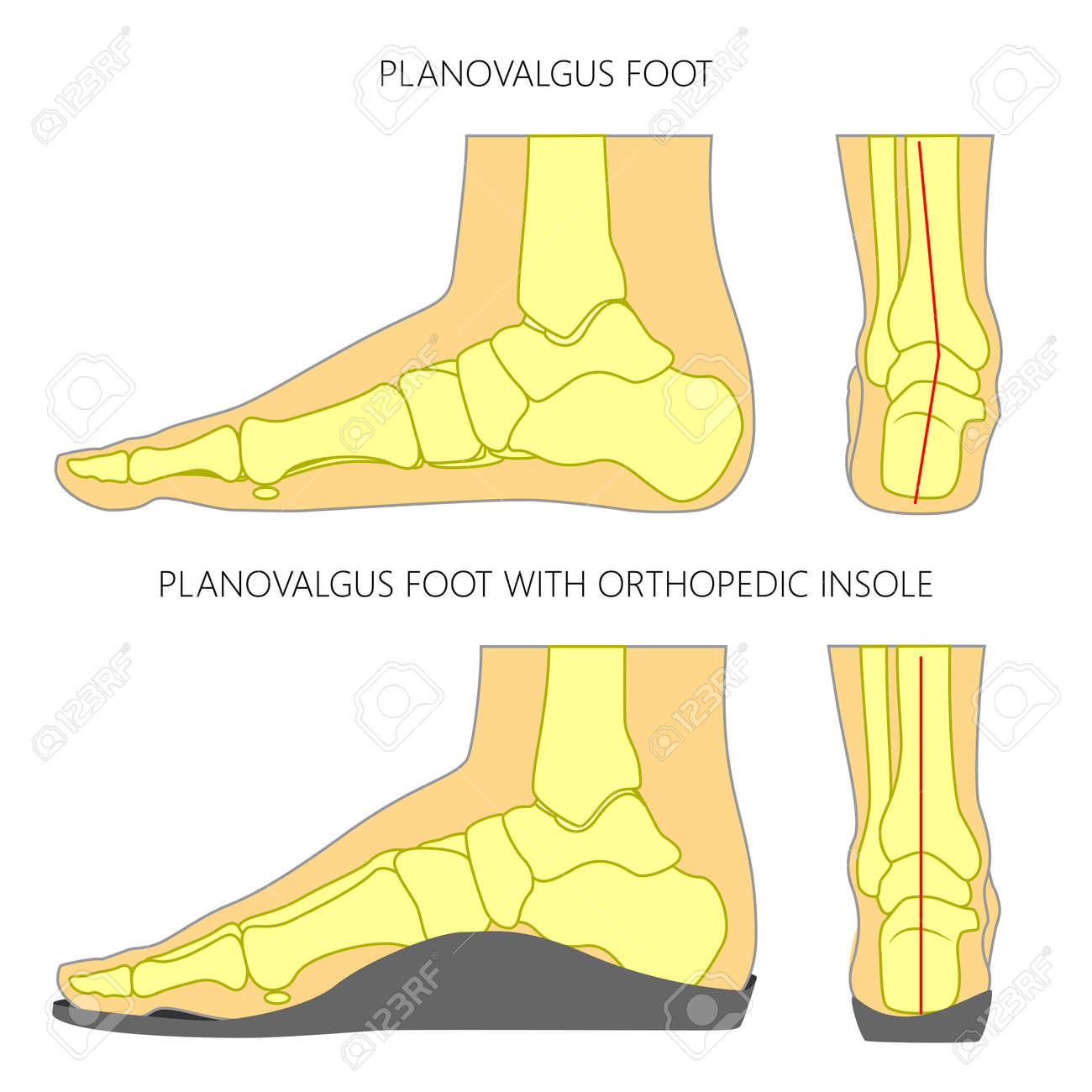 Illustration of Flat foot without and with orthopedic insole. Side and back views. - 75348289 Illustration of Flat foot without and with orthopedic insole. Side and back views. - 75348289