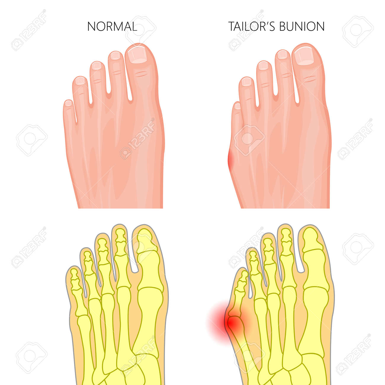 Illustration of the normal foot and Tailor's bunion. External and skeletal views. Used: gradient, transparency, Blend mode. - 75348299 Illustration of the normal foot and Tailor's bunion. External and skeletal views. Used: gradient, transparency, Blend mode. - 75348299