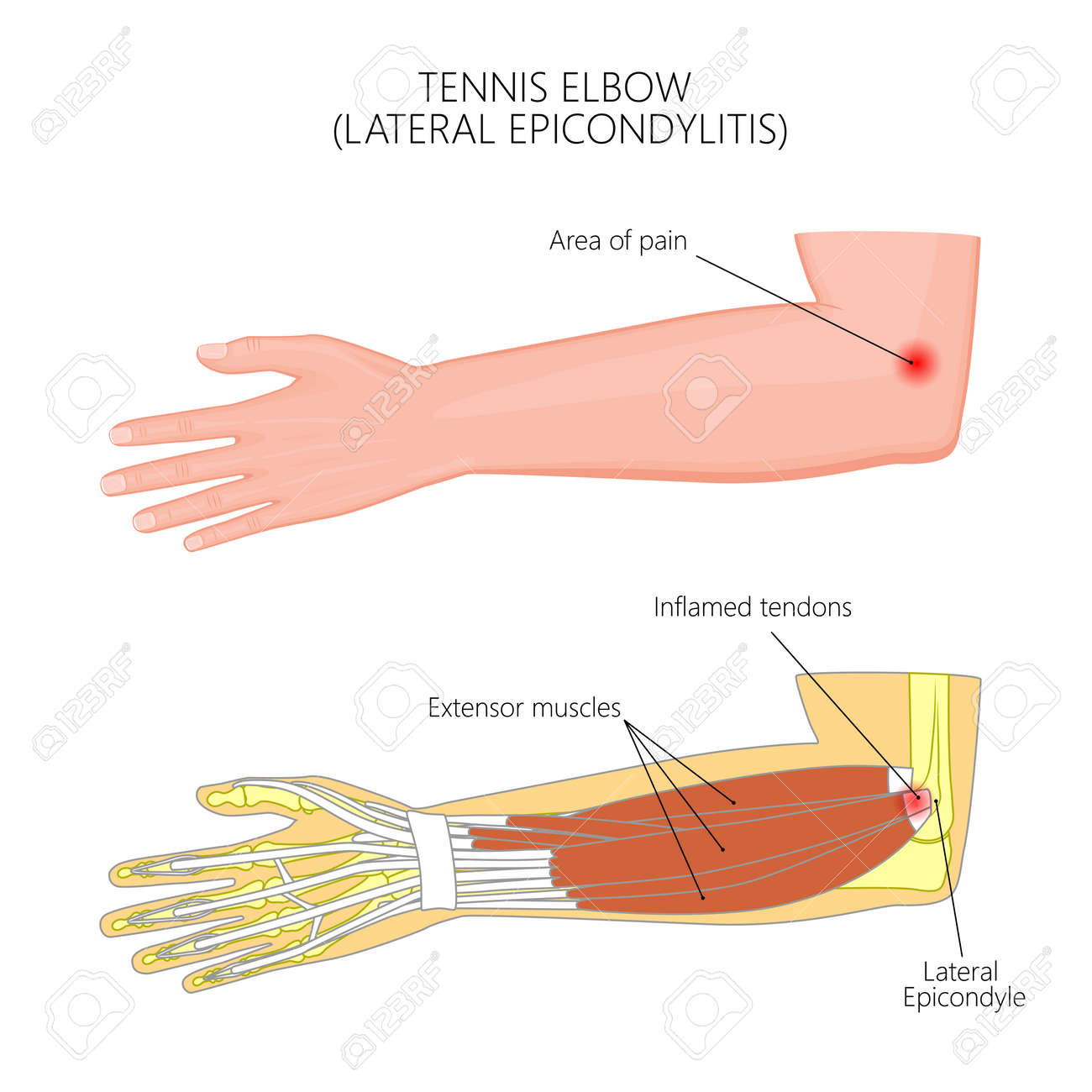 Epicondylitis Epicondylitis