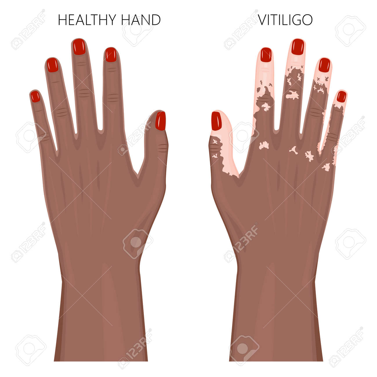 色付きの爪と白斑 皮膚の色の損失 色素沈着を持つ健康な人間アフロアメリカンの手のベクトルイラスト ドーサル ビュー 広告 医療出版物のために Eps 8 のイラスト素材 ベクタ Image