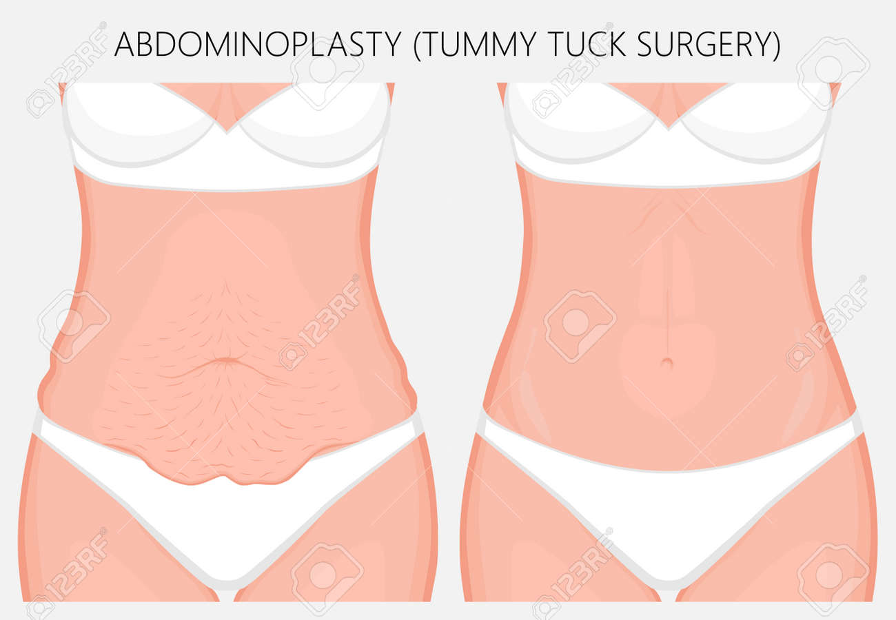 リアルなベクトルのイラスト 腹部形成術 女性のおなかタック形成外科 正面図化粧品プラスチックの手順の広告のため 胃のシャント ダイエット 医学の出版物のために Eps 8 のイラスト素材 ベクタ Image