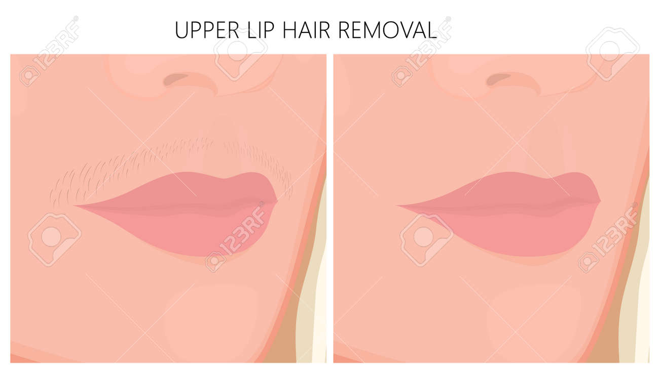 Vector Illustration Of Upper Lip Hair Removal Before And After Cosmetic Procedure. For Advertising And Beauty Publications. Royalty Free SVG, Cliparts, Vectors, And Stock Illustration. Image 101212914. Vector Illustration Of Upper Lip Hair Removal Before And After Cosmetic Procedure. For Advertising And Beauty Publications. Royalty Free SVG, Cliparts, Vectors, And Stock Illustration. Image 101212914.