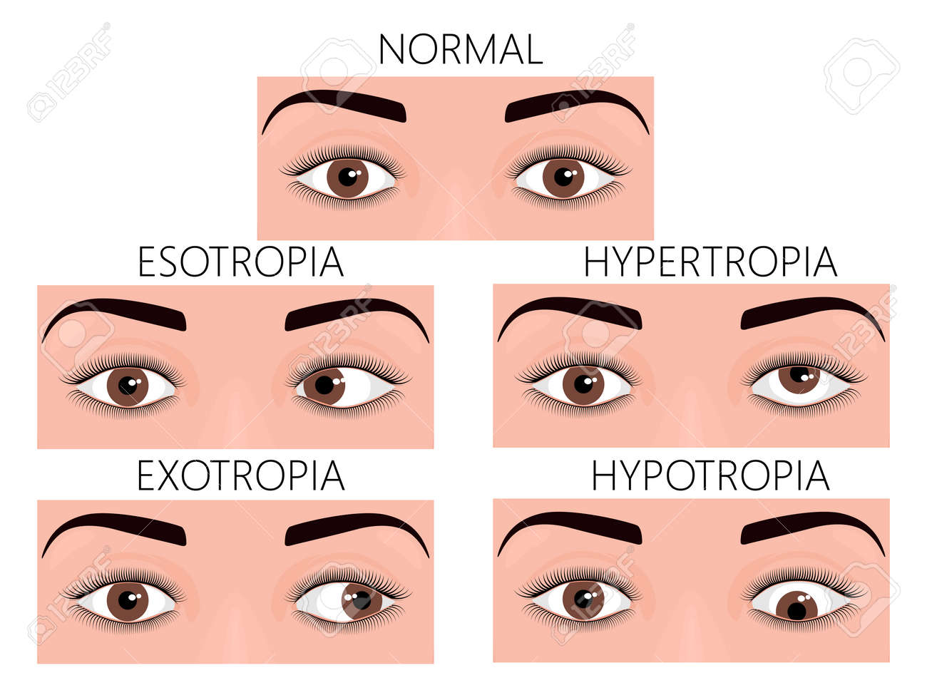vector illustration of normal human eyes and eyes with problem human problem