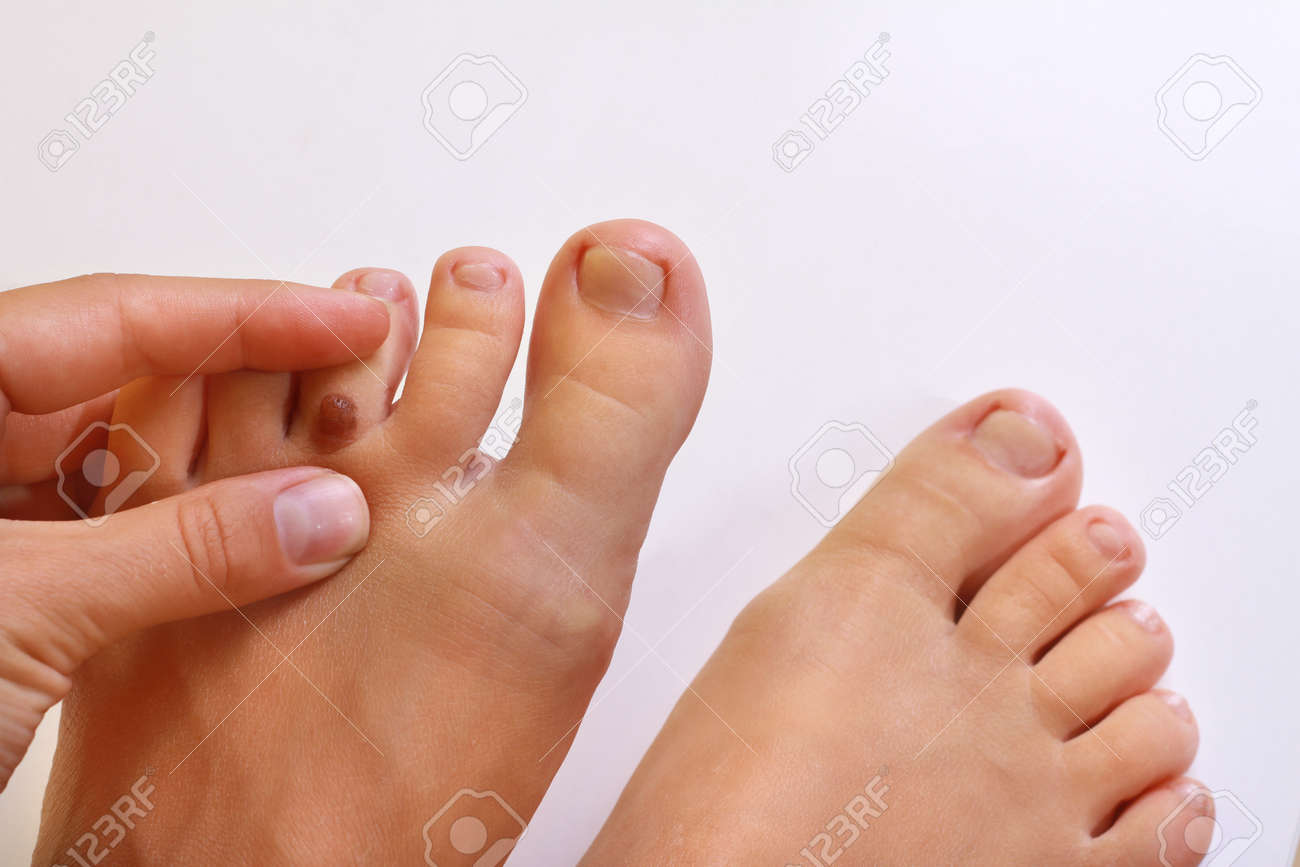 医師 皮膚科医の手は患者の地上絵の痣を調べます 良性のほくろをチェックします Bithmark と女性の脚の指 の写真素材 画像素材 Image