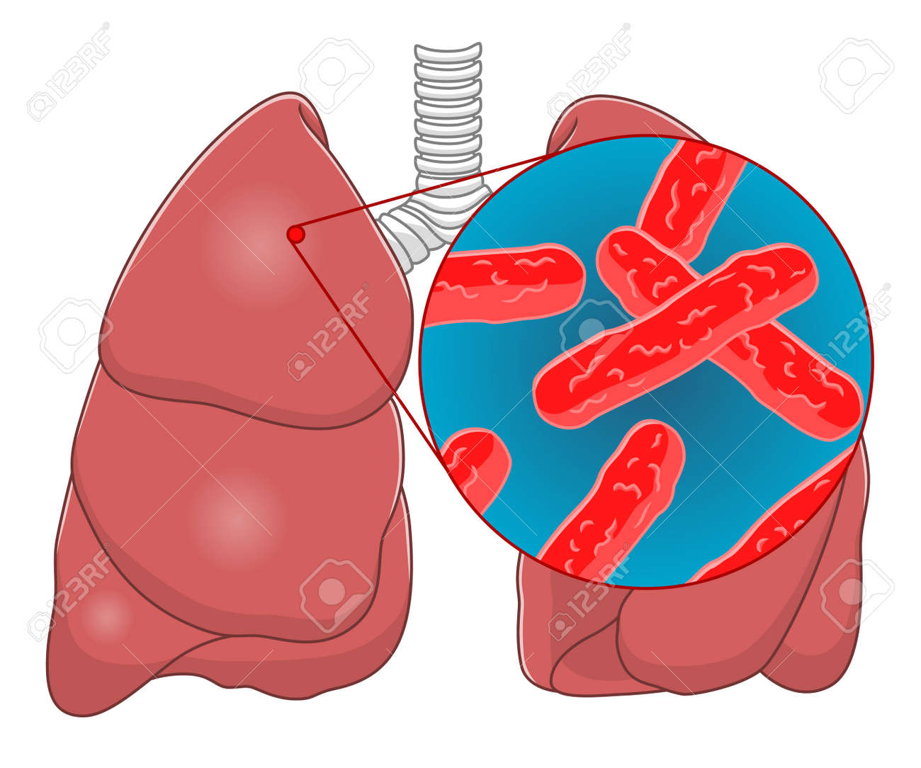 結核の図のイラスト素材 ベクタ Image