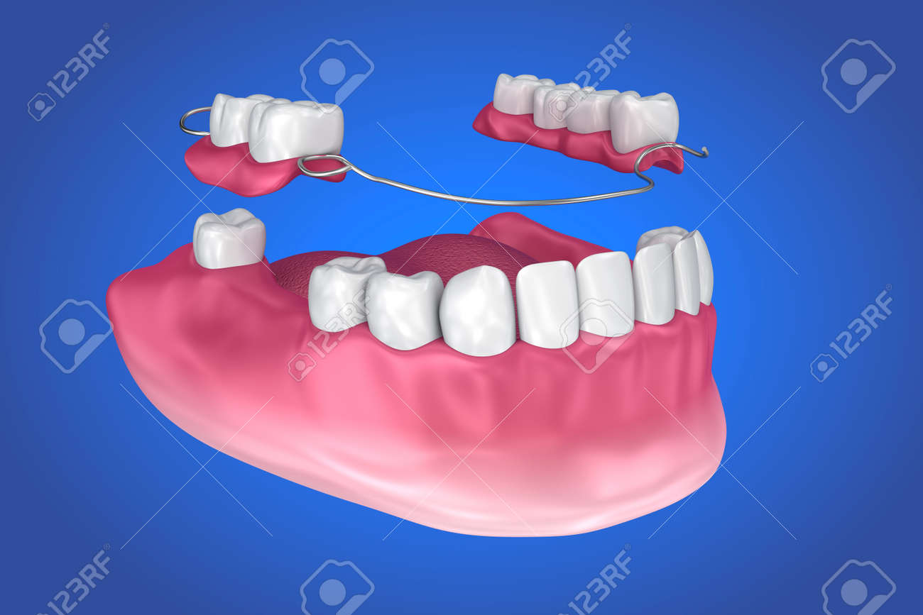 部分床義歯 医学的に正確な 3 D イラスト の写真素材 画像素材 Image