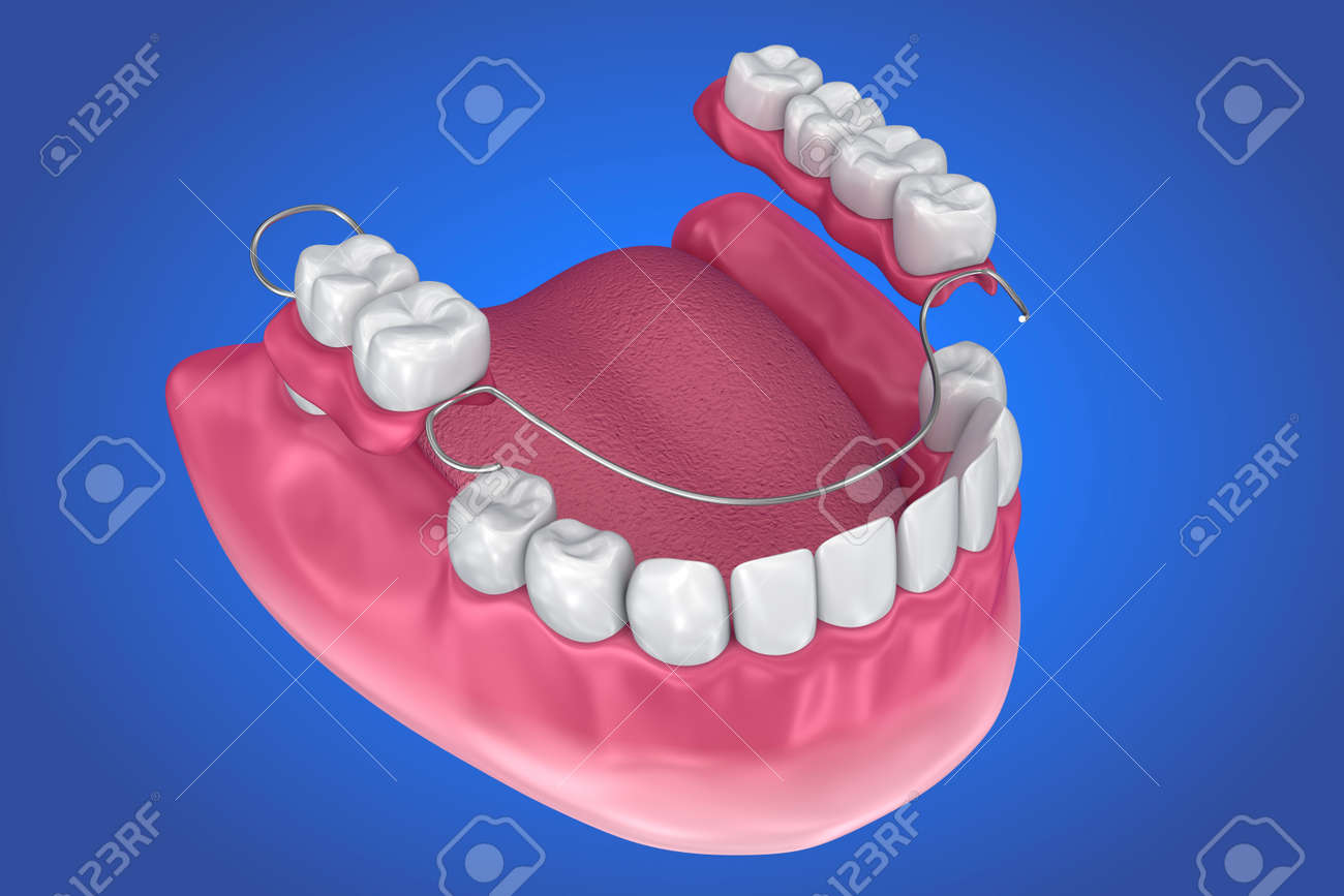 部分床義歯 医学的に正確な 3 D イラスト の写真素材 画像素材 Image