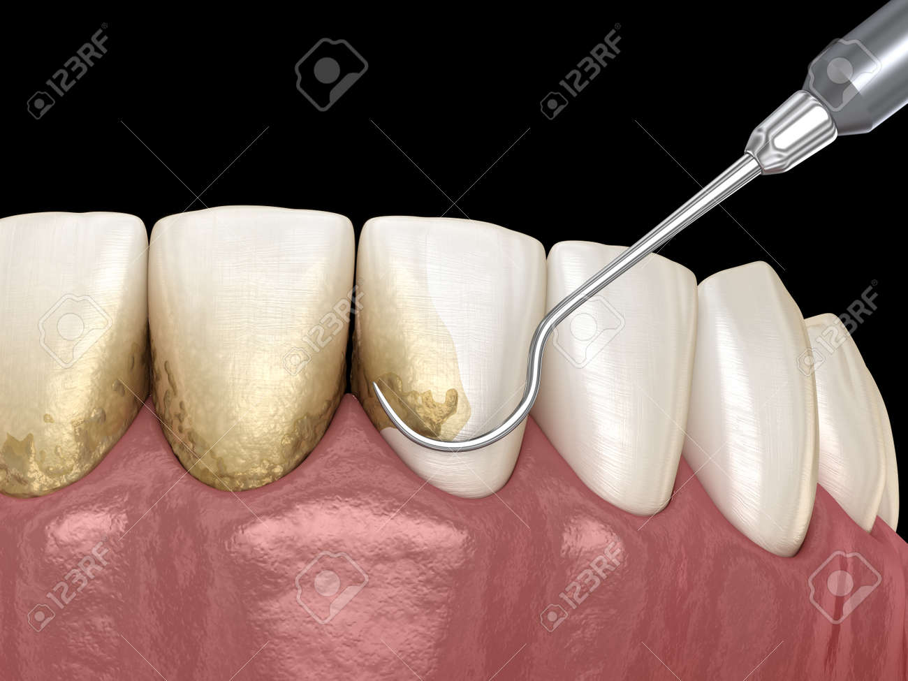 stock illustration root planing