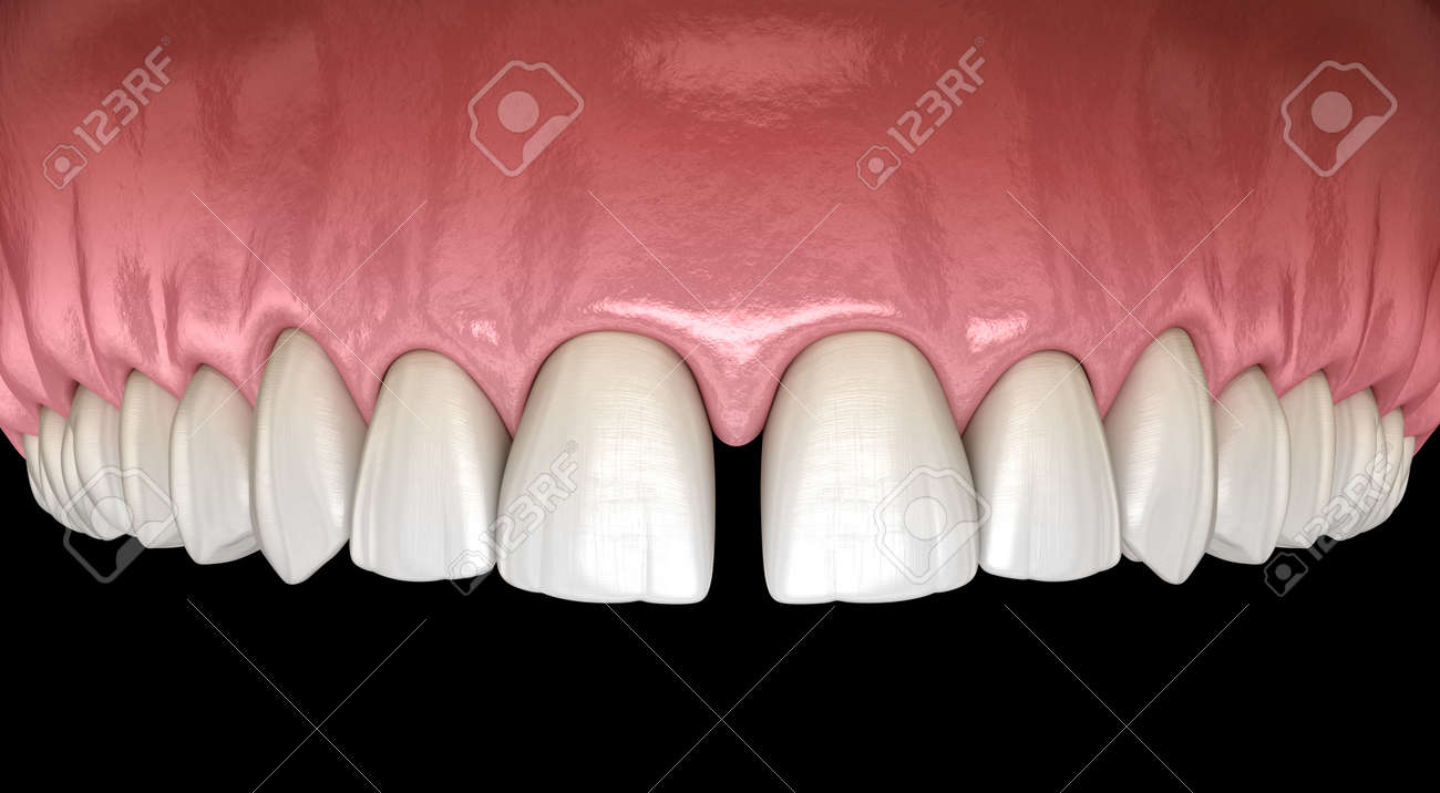 stock illustration incisors