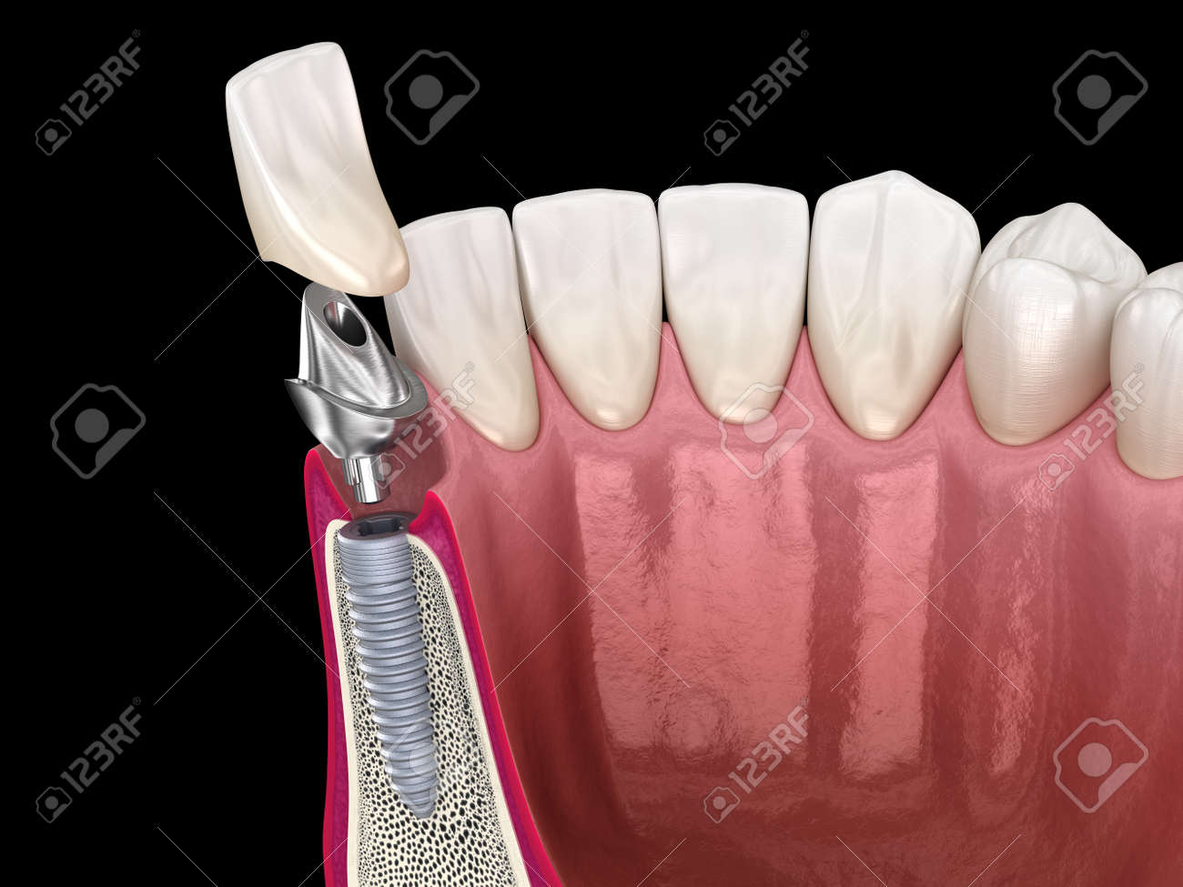 Custom Abutment Dental Implant And Ceramic Crown Medically Accurate Tooth 3d Illustration Stock Photo Picture And Royalty Free Image Image 154783225