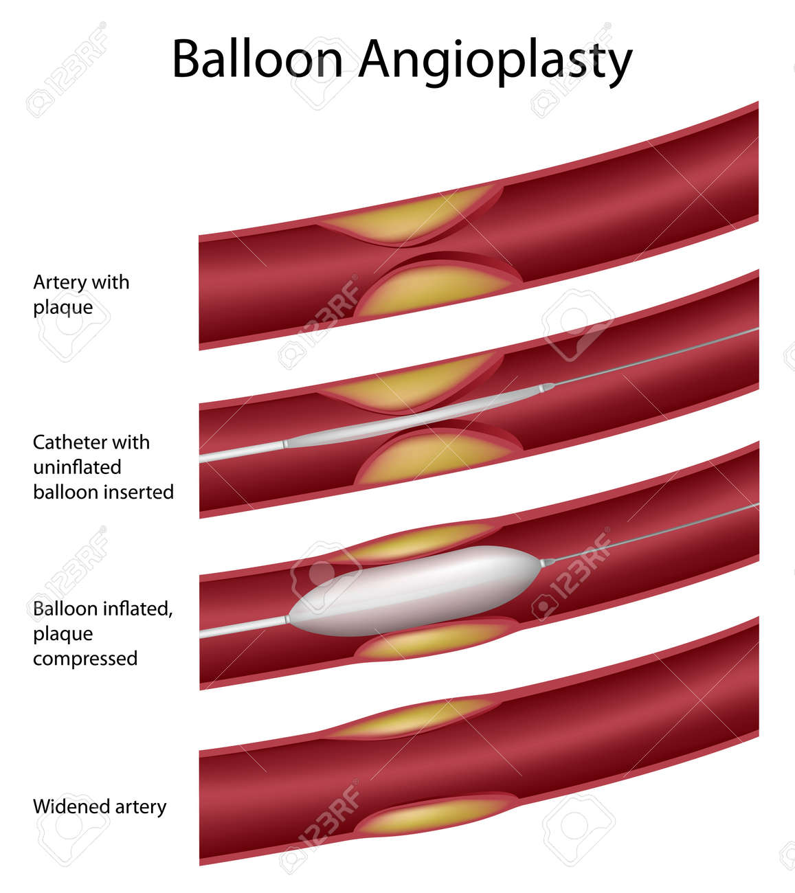 balloon angioplasty procedure royalty free cliparts vectors and