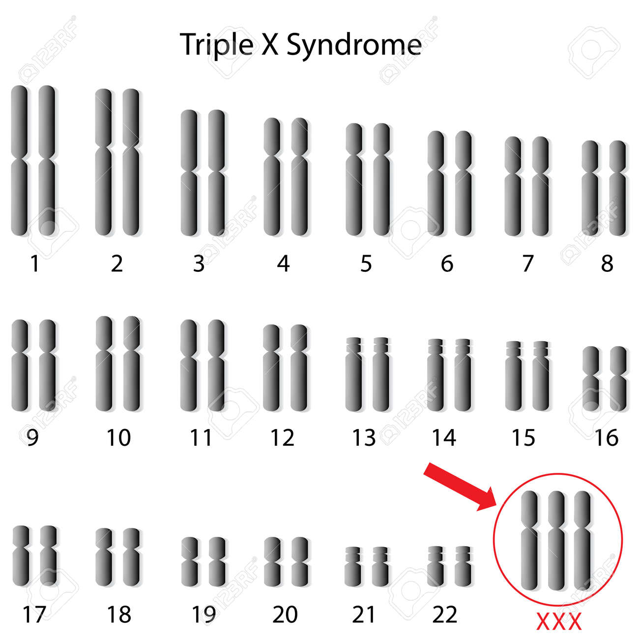 트리플 X 증후군 로열티 무료 사진, 그림, 이미지 그리고 스톡포토그래피. Image 15618034