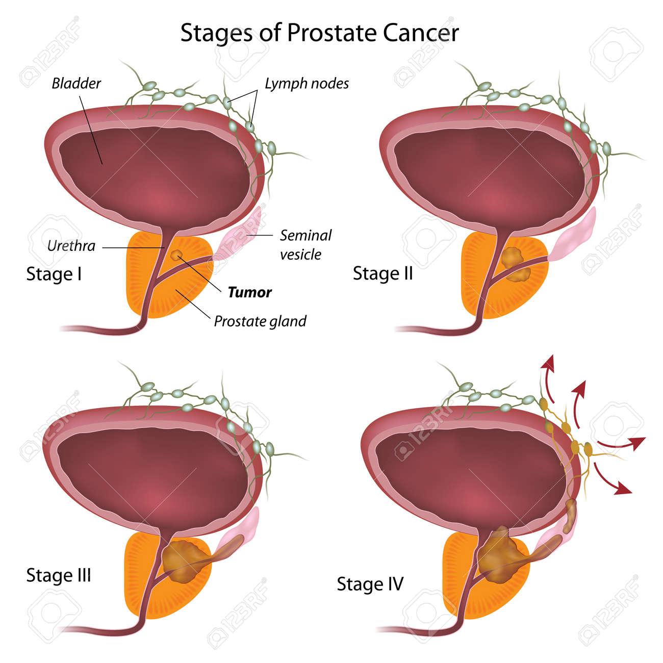 cáncer de próstata y coagulación sanguínea 2020