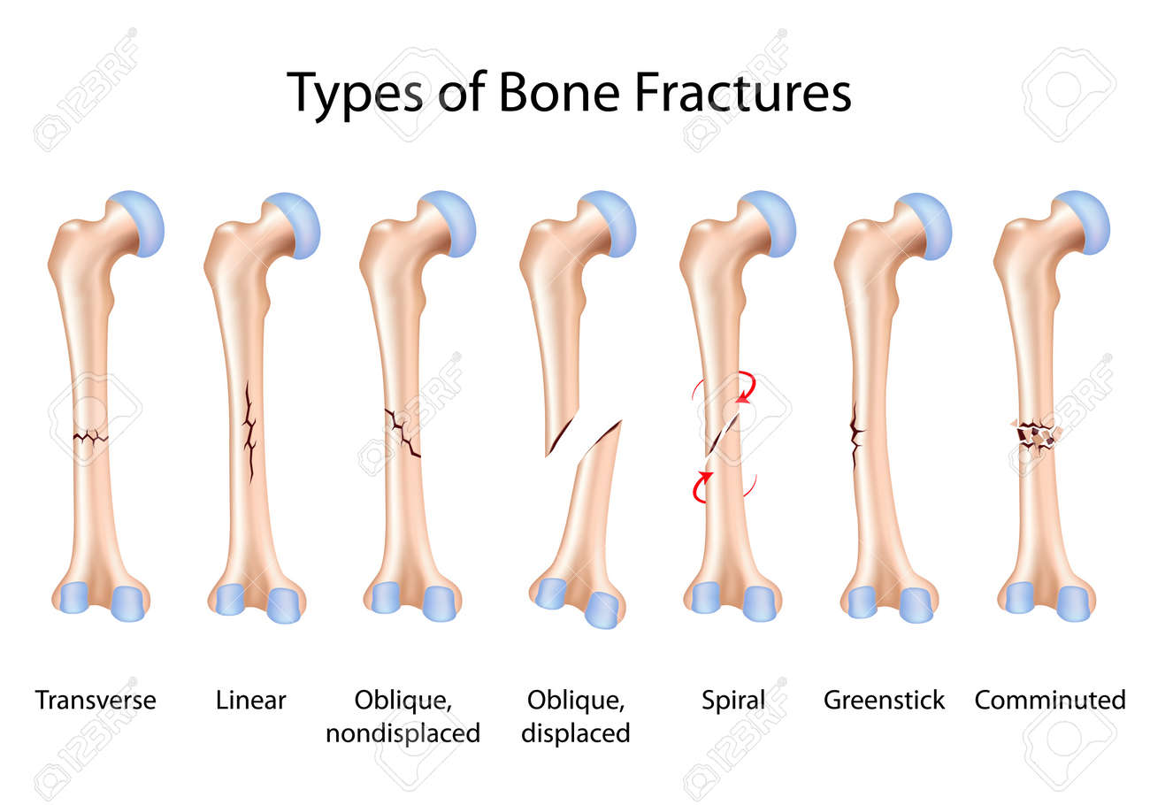 Types Of Bone Fractures Royalty Free Cliparts Vectors And Stock Illustration Image 16801387