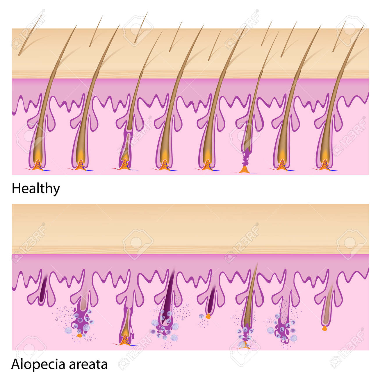 normal hair and alopecia areata royalty free cliparts, vectors, and Names and Body Part Diagram normal hair and alopecia areata stock vector 17588318