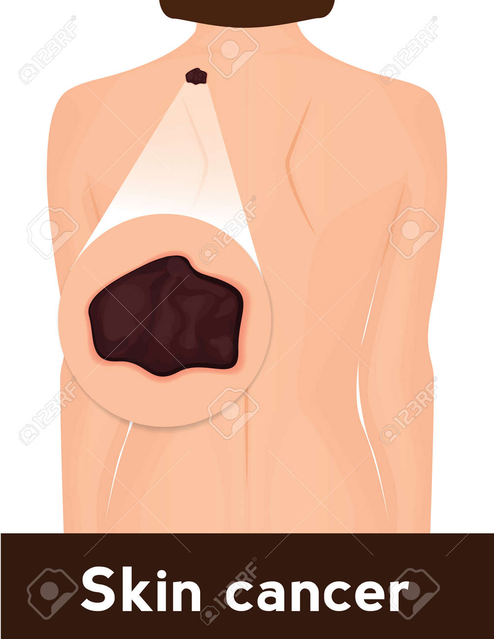 Affiche Médicale Sur Le Cancer De La Peau Illustration De Femme Avec Malignat Mole Clip Art Libres De Droits Vecteurs Et Illustration Image 73853108