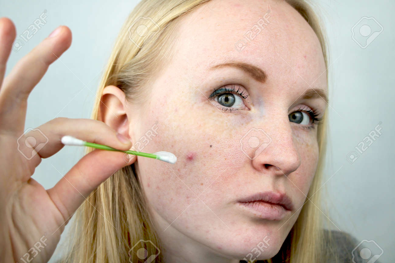 Young Woman With Acne. Applying Ointment To The Pimple. Beauty, Skin Care  Lifestyle Concept. Фотография, картинки, изображения и сток-фотография без  роялти. Image 120279125