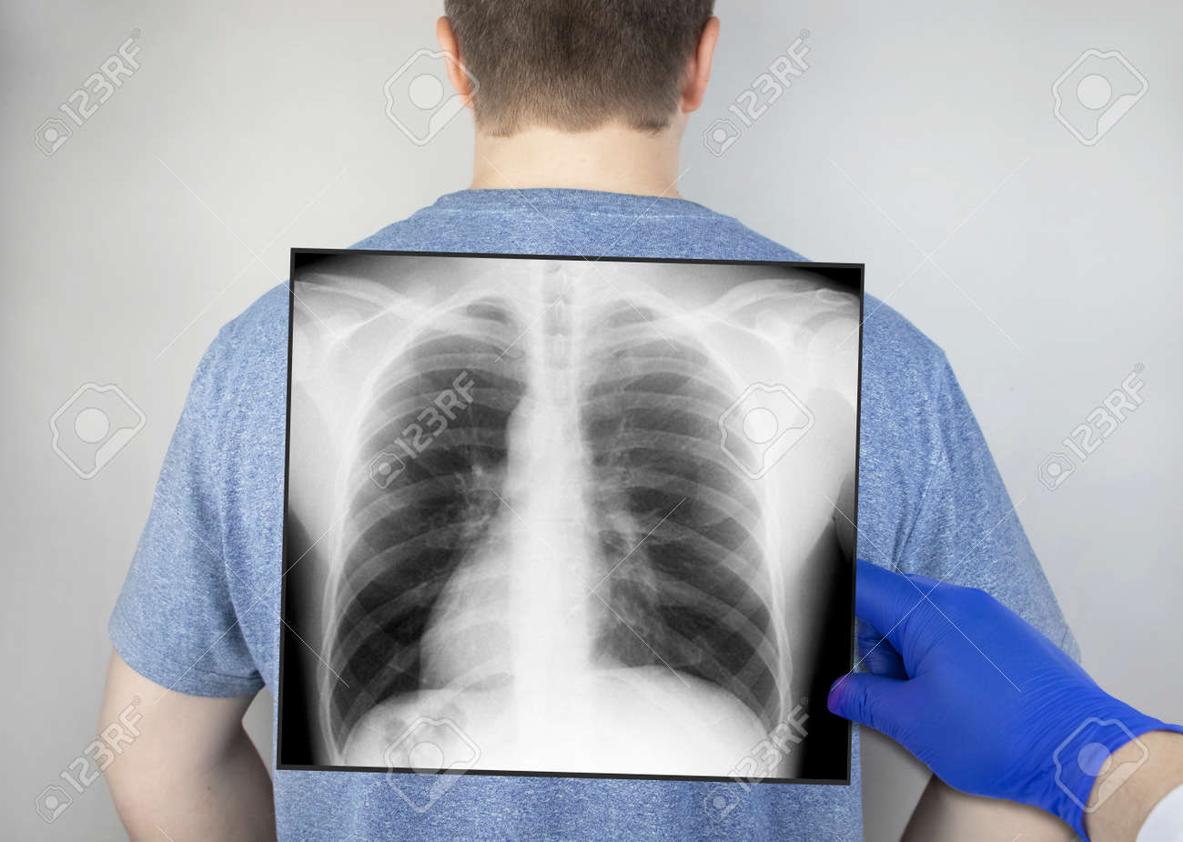 A Chest X Ray Of A Man From The Back A Doctor Radiologist Is Stock Photo Picture And Royalty Free Image Image 148384927