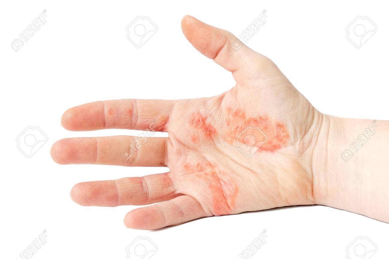 Close Up Photo Of A Hand Suffering Of Eczema Stock Photo Picture And Royalty Free Image Image 74482972