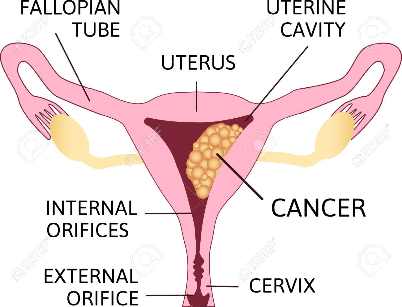 Uterine Cancer Vector Poster Or Chart With Cancerous Tumor Cells Royalty Free Cliparts Vectors And Stock Illustration Image 144111395