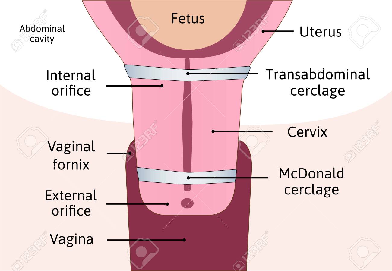 Transabdominal Cerclage Tightening Of Cervix Opening During Pregnancy.  Anatomy Of Cervix, Cerclage. Uterus With Cervix Weakness And Blue Cerclage  On It. Vector Illustration Marked With Lines. Medical Drawing Isolated  Royalty Free SVG,, image size:1300x899