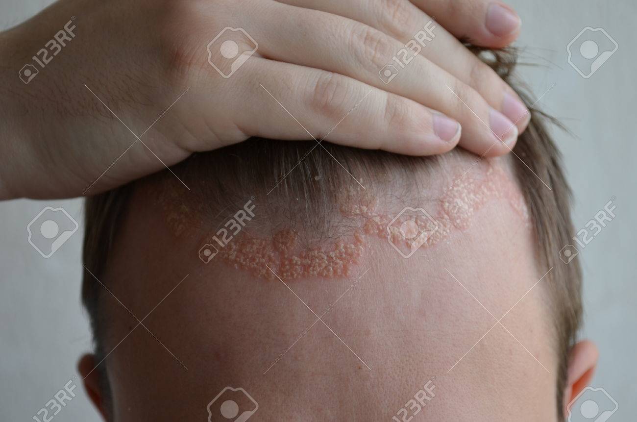 Tipos de dermatitis en el cuero cabelludo