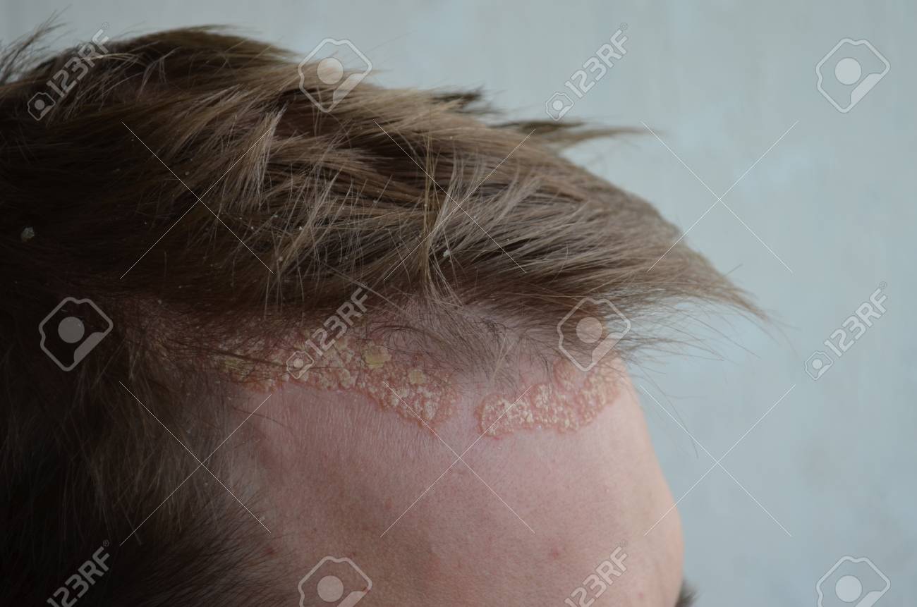 乾癬皮膚クローズ アップ 頭皮 皮膚炎や湿疹 肌問題皮膚の写真 の写真素材 画像素材 Image