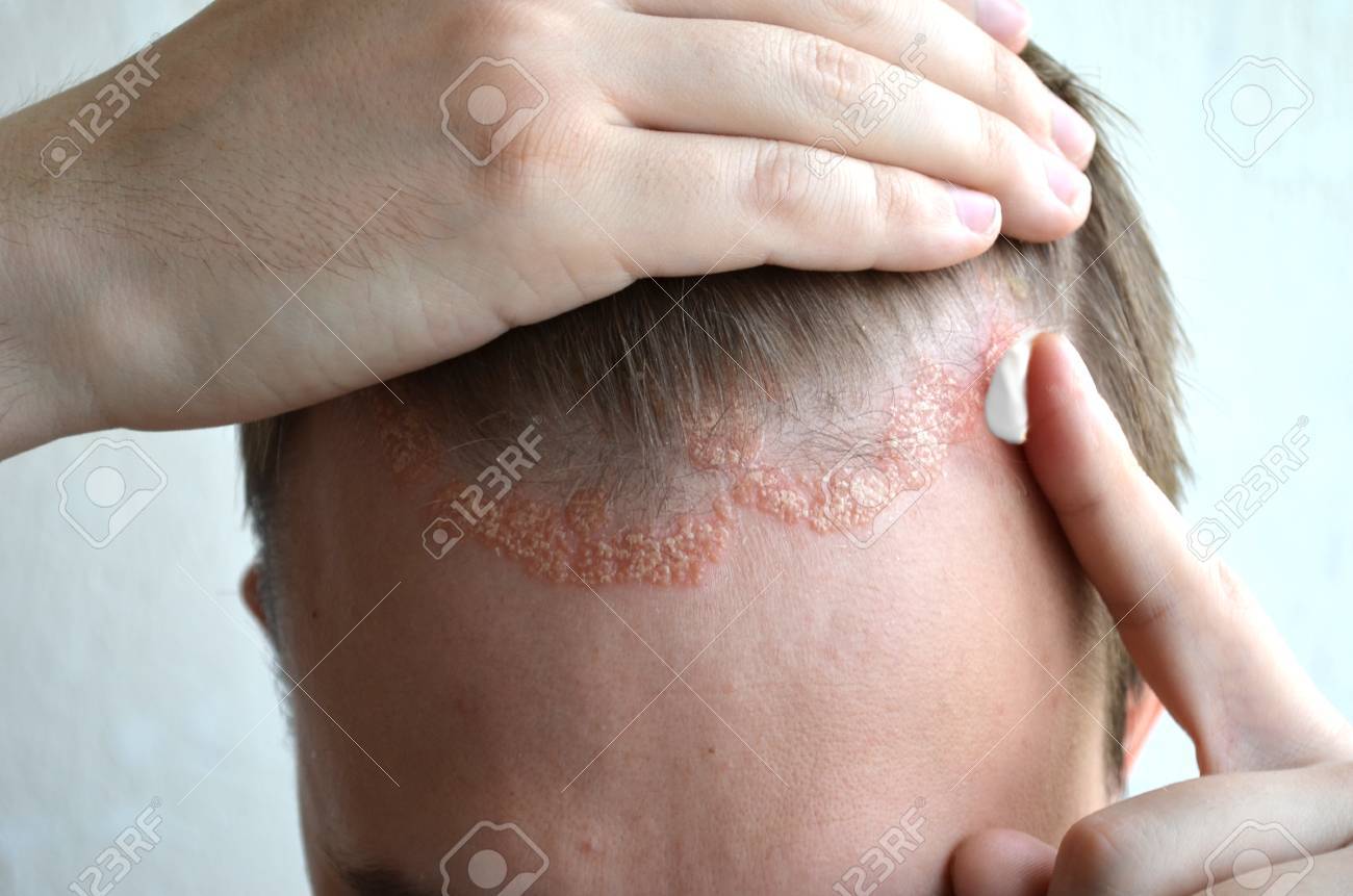 Small Bumps On Forehead Causes And How To Get Rid Of Them