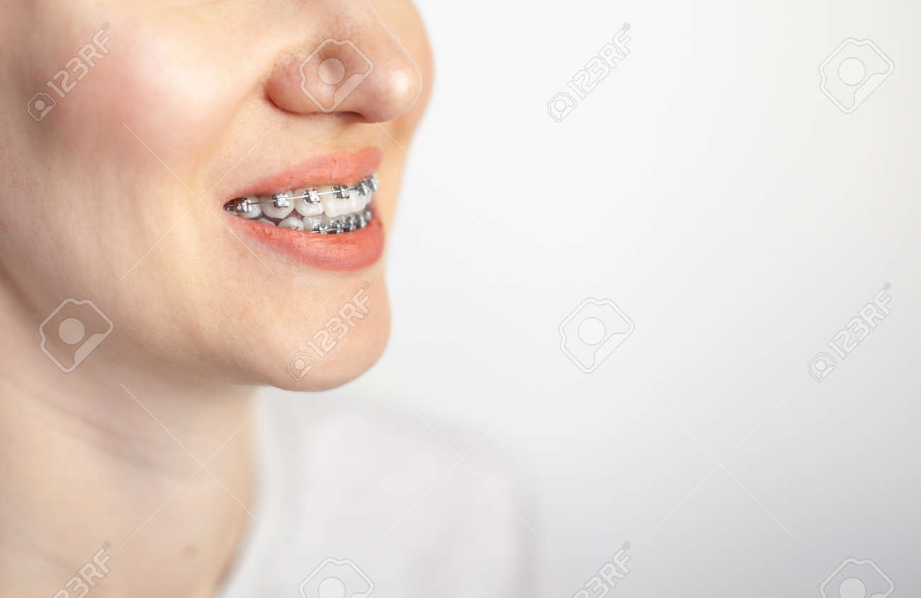 The smile of a young girl with braces on her white teeth. Teeth straightening. Malocclusion. Dental care. - 166354656 The smile of a young girl with braces on her white teeth. Teeth straightening. Malocclusion. Dental care. - 166354656