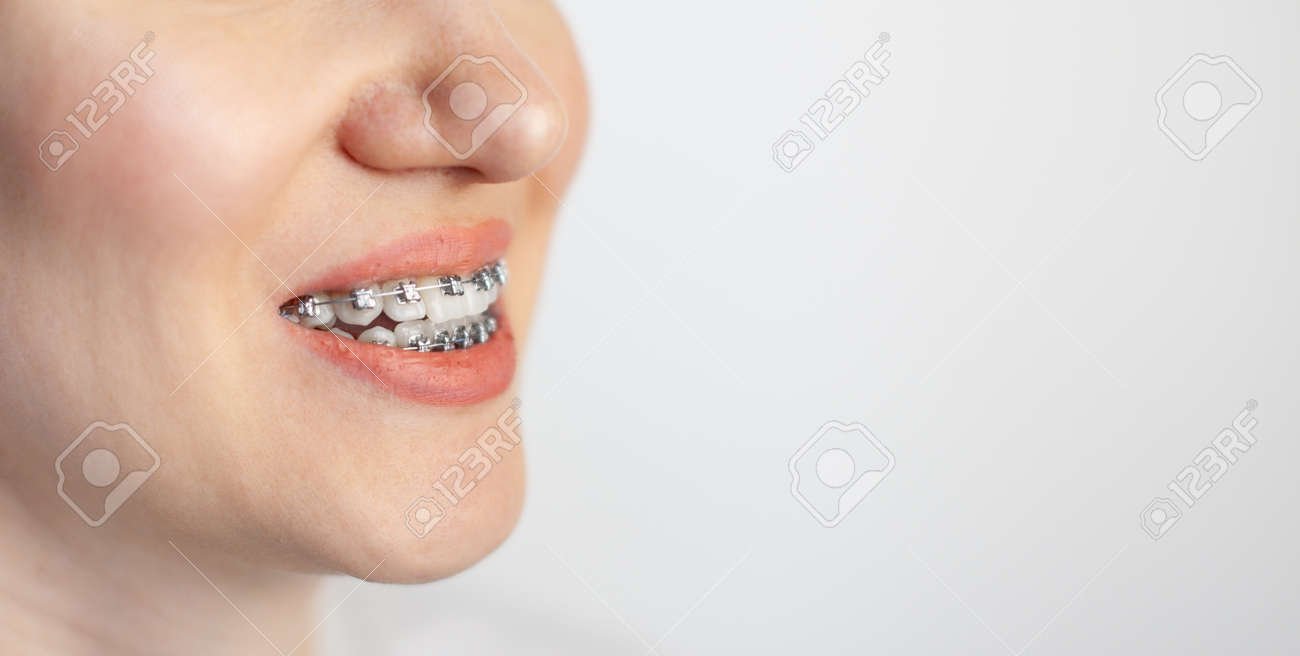 The smile of a young girl with braces on her white teeth. Teeth straightening. Malocclusion. Dental care. - 169208860 The smile of a young girl with braces on her white teeth. Teeth straightening. Malocclusion. Dental care. - 169208860