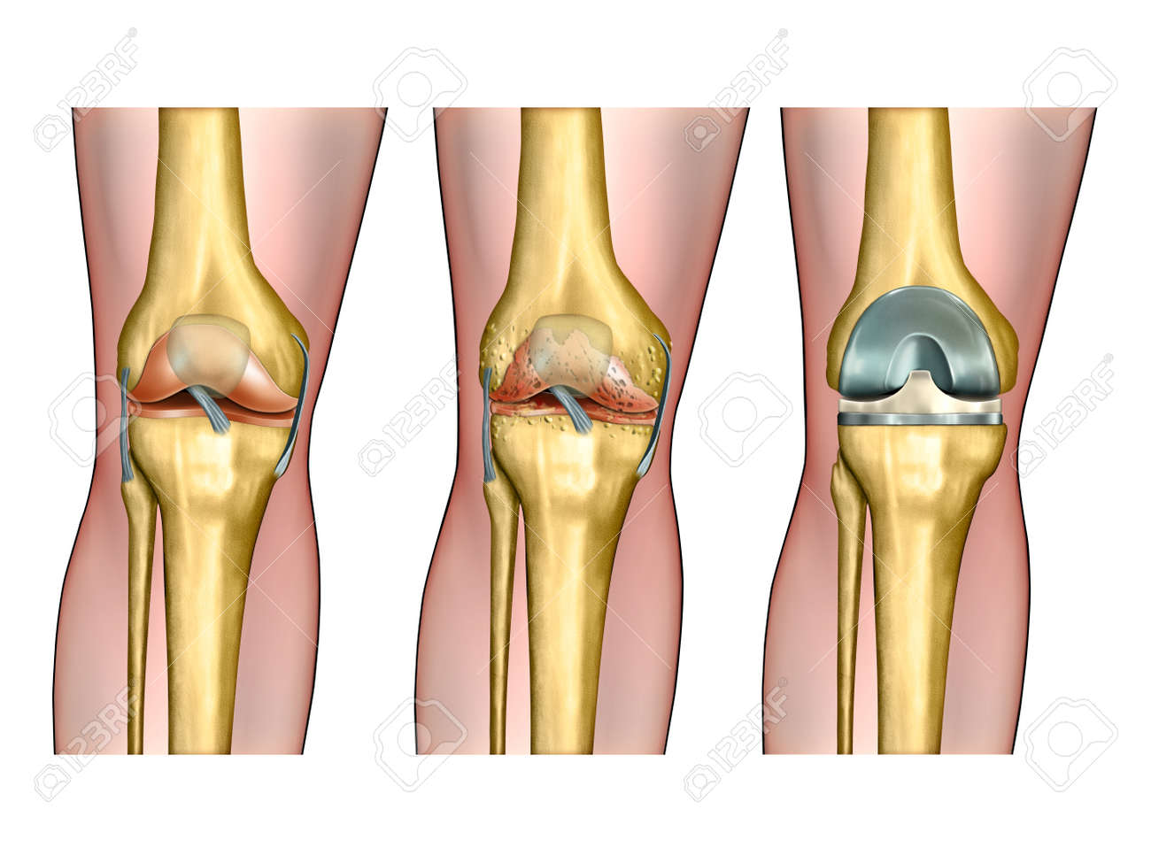 artritis inflamatoria rodilla artritis inflamatoria rodilla