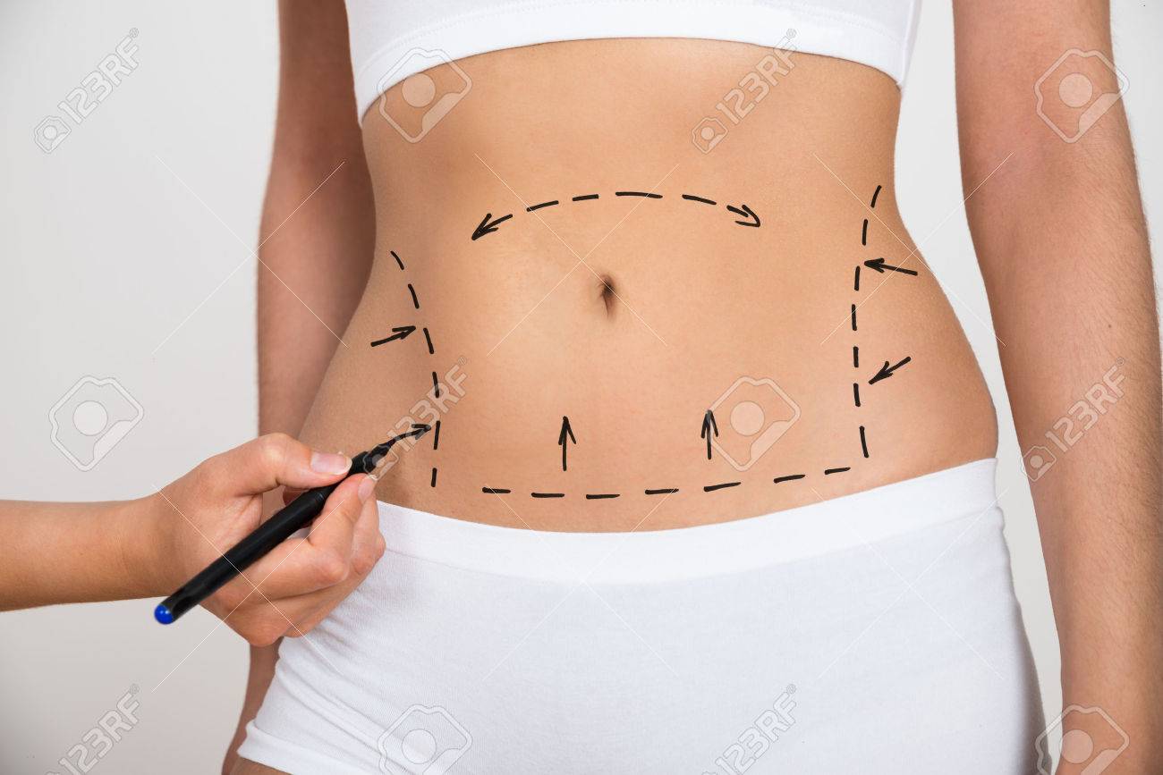 celulitis en abdomen