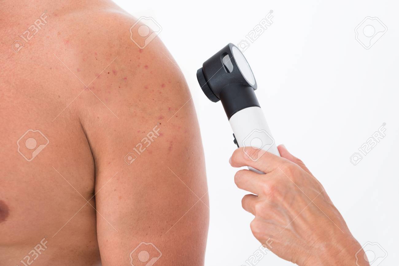 Close Up Of Person Hands Examining Acne Skin Of Man With Dermatoscope Stock Photo Picture And Royalty Free Image Image 47562352